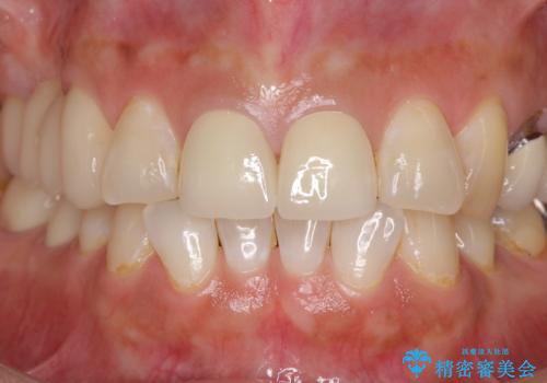 不調和な前歯の審美歯科治療の治療後
