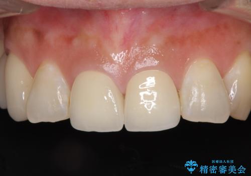 不調和な前歯の審美歯科治療の症例 治療後