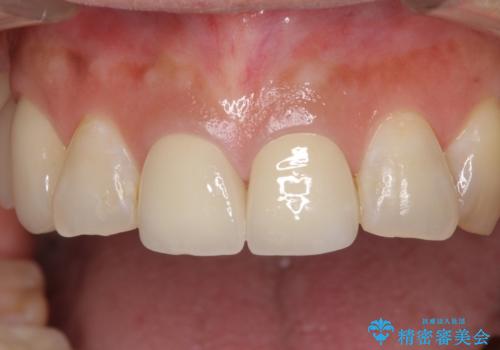 不調和な前歯の審美歯科治療の治療後