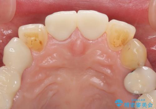 不調和な前歯の審美歯科治療の治療後