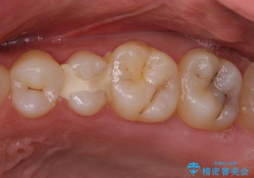 他院で治療中の歯　ゴールドインレーによる修復治療の症例 治療前