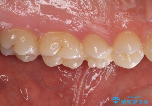 他院で治療中の歯 ゴールドインレーによる修復治療の治療前