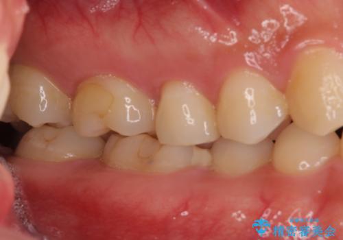 他院で治療中の歯 ゴールドインレーによる修復治療の治療前