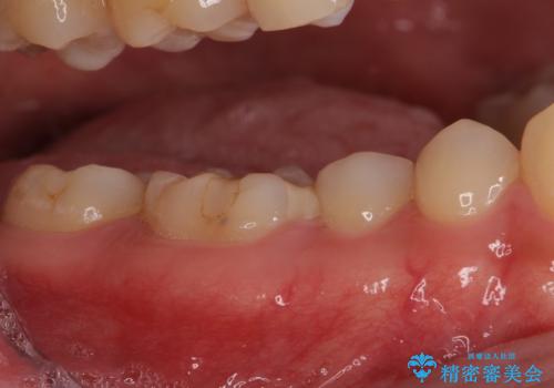 他院で治療中の歯　ゴールドインレーによる修復治療の治療前