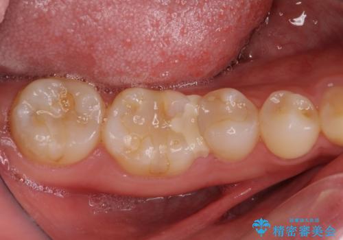 他院で治療中の歯 ゴールドインレーによる修復治療の治療前