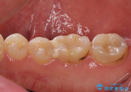 他院で治療中の歯 ゴールドインレーによる修復治療の治療前