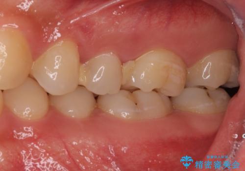他院で治療中の歯　ゴールドインレーによる修復治療の治療前
