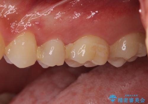 他院で治療中の歯 ゴールドインレーによる修復治療の治療前