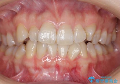 ハーフリンガル　犬歯のねじれ　歯根の外部吸収している歯を抜歯の症例 治療前