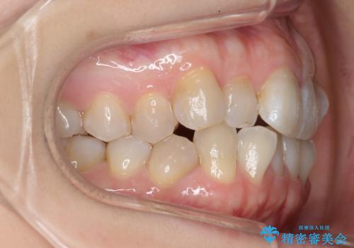 ハーフリンガル　犬歯のねじれ　歯根の外部吸収している歯を抜歯の治療前