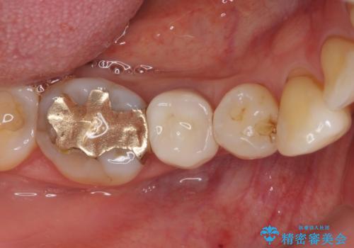 歯に穴があいた　奥歯のセラミック治療の症例 治療後