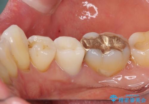 歯に穴があいた 奥歯のセラミック治療の治療後