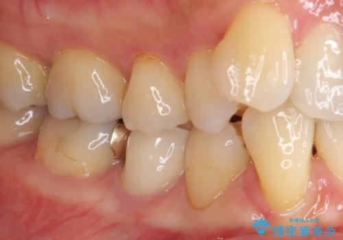 歯に穴があいた 奥歯のセラミック治療の治療後