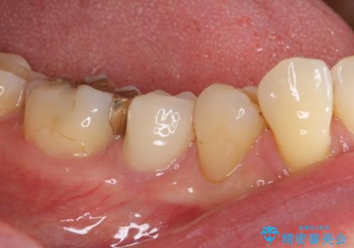 歯に穴があいた　奥歯のセラミック治療の治療後