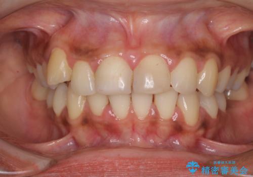 継ぎ接ぎだらけで歯肉も腫れてしまった前歯 オールセラミックの審美歯科治療の治療前