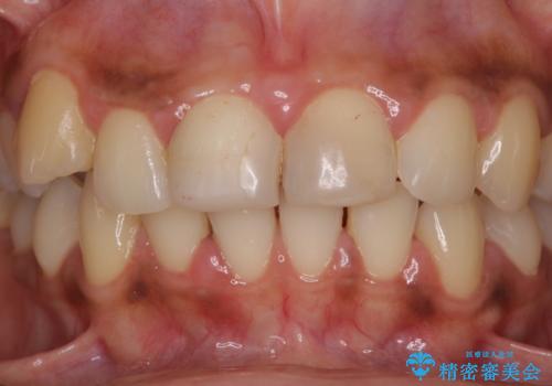 継ぎ接ぎだらけで歯肉も腫れてしまった前歯 オールセラミックの審美歯科治療の治療前