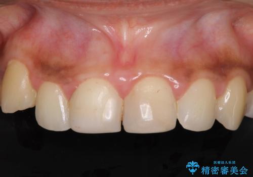 継ぎ接ぎだらけで歯肉も腫れてしまった前歯 オールセラミックの審美歯科治療の症例 治療前