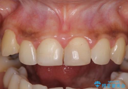 継ぎ接ぎだらけで歯肉も腫れてしまった前歯 オールセラミックの審美歯科治療の治療前