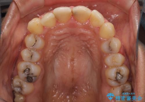 継ぎ接ぎだらけで歯肉も腫れてしまった前歯 オールセラミックの審美歯科治療の治療前