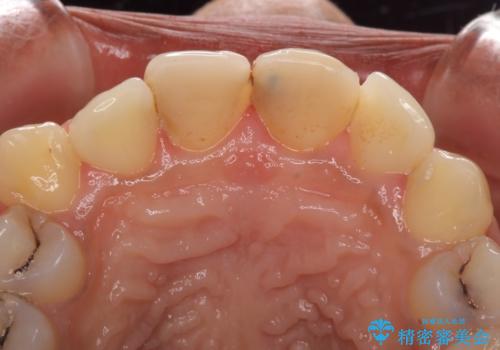 継ぎ接ぎだらけで歯肉も腫れてしまった前歯 オールセラミックの審美歯科治療の治療前