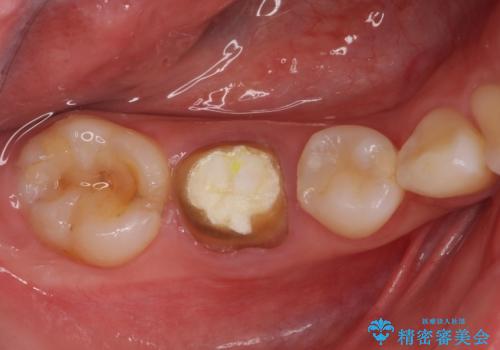 治療の度に痛んだ歯 セラミッククラウンによる補綴治療の治療前