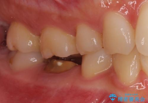 治療の度に痛んだ歯 セラミッククラウンによる補綴治療の治療前