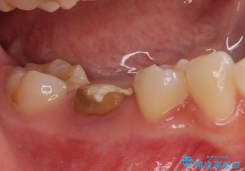治療の度に痛んだ歯 セラミッククラウンによる補綴治療の治療前