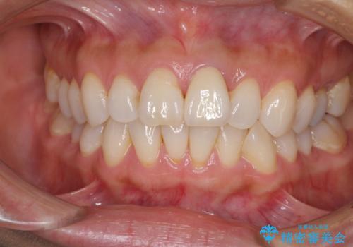 変色した前歯が気になる オールセラミッククラウンの治療後