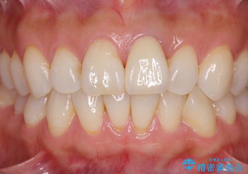 変色した前歯が気になる オールセラミッククラウンの治療後
