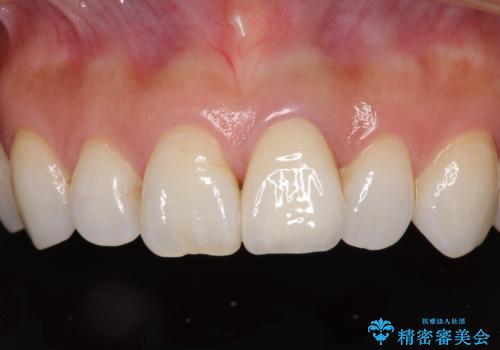 変色した前歯が気になる オールセラミッククラウンの治療後