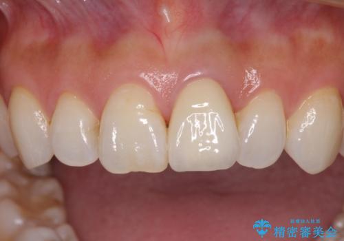 変色した前歯が気になる オールセラミッククラウンの治療後