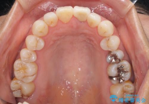 変色した前歯が気になる オールセラミッククラウンの治療後