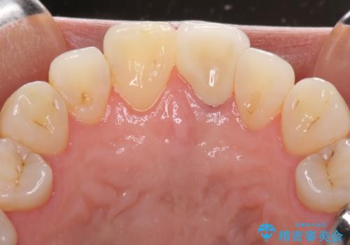 変色した前歯が気になる オールセラミッククラウンの治療後