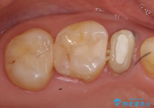 オールセラミッククラウン 根管治療 奥歯の補綴の症例 治療前