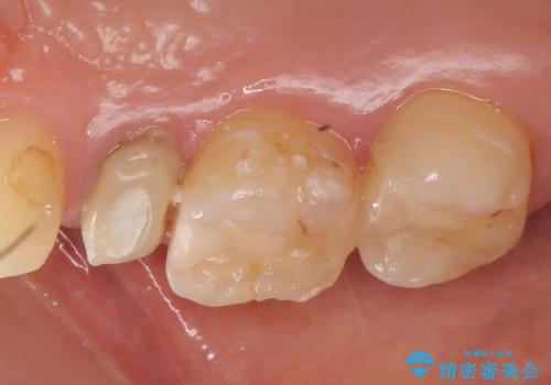 オールセラミッククラウン 根管治療 奥歯の補綴の治療前