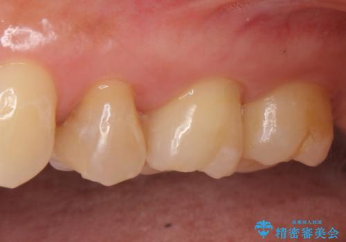 オールセラミッククラウン 根管治療後の補綴の治療前