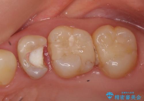 オールセラミッククラウン 根管治療後の補綴の治療前