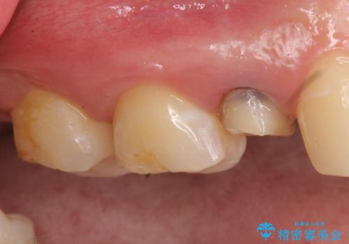 オールセラミッククラウン 根管治療 奥歯の補綴の治療前