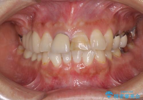 不調和な前歯の審美歯科治療の治療前