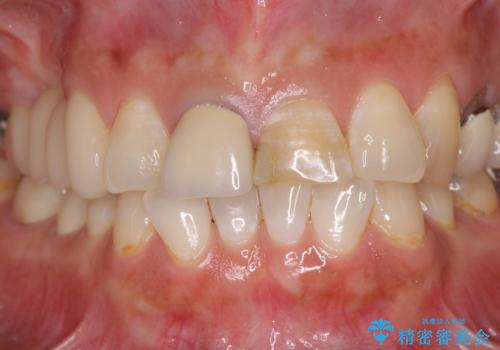 不調和な前歯の審美歯科治療の治療前