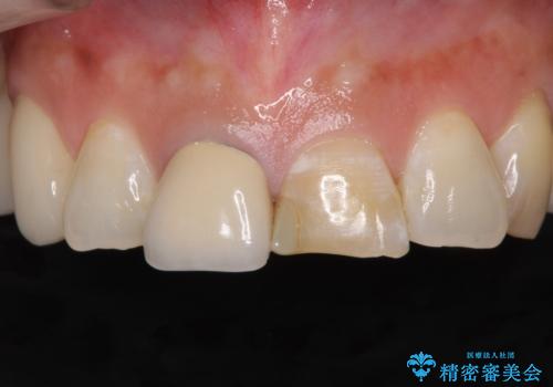 不調和な前歯の審美歯科治療の症例 治療前