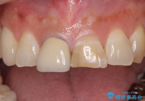 不調和な前歯の審美歯科治療の治療前