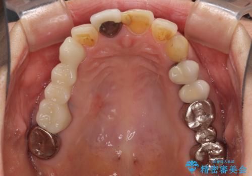 不調和な前歯の審美歯科治療の治療前