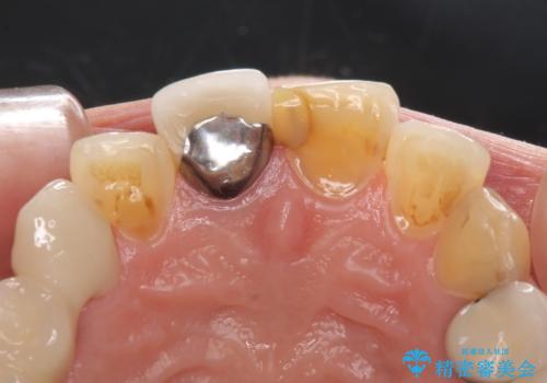 不調和な前歯の審美歯科治療の治療前