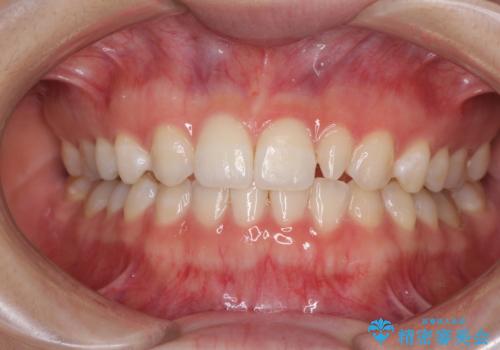 海外転居前に気になる前歯を整えたい　上下前歯の部分矯正の症例 治療後
