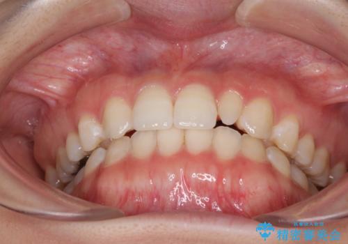 海外転居前に気になる前歯を整えたい 上下前歯の部分矯正の治療後