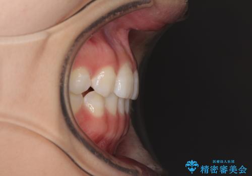 海外転居前に気になる前歯を整えたい 上下前歯の部分矯正の治療後