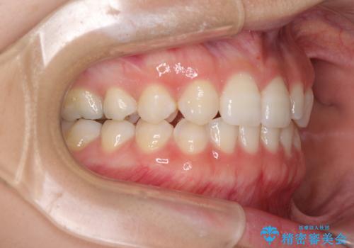 海外転居前に気になる前歯を整えたい 上下前歯の部分矯正の治療後