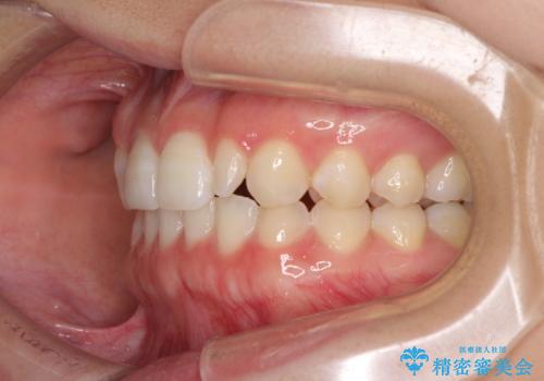 海外転居前に気になる前歯を整えたい 上下前歯の部分矯正の治療後