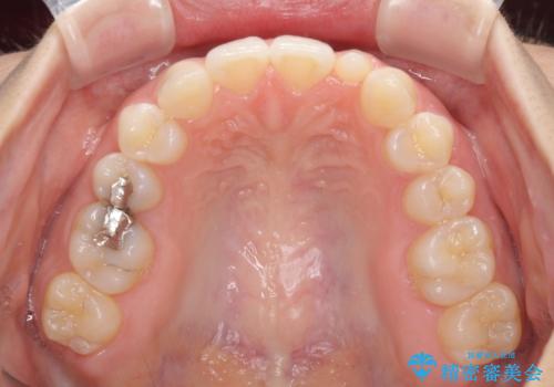 海外転居前に気になる前歯を整えたい　上下前歯の部分矯正の治療後